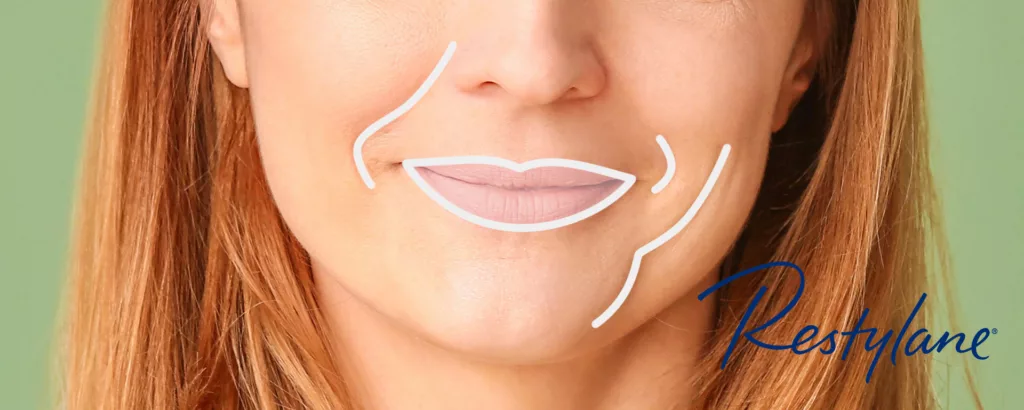 diagram showing what restylane addresses such as smile lines, marionette lines, thin lips, etc