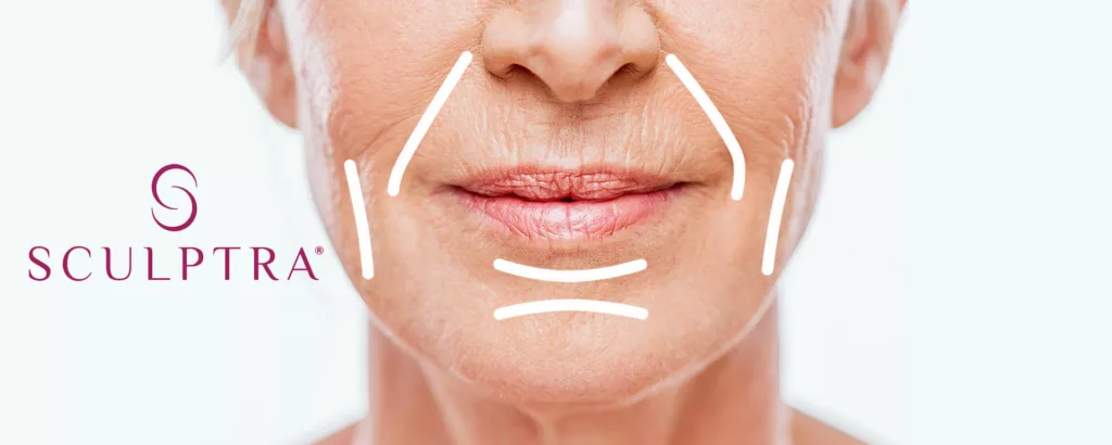 diagram showing what Sculptra injections can treat like wrinkles and folds as well as stimulate collagen production