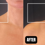 before and after botox or daxxify injections for traptox