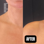 before and after botox or daxxify injections for traptox