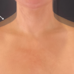 before and after botox or daxxify injections for traptox