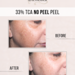 TCA-Peel-Chemical-Peel-Santa-Rosa-Healdsburg