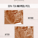 TCA-Peel-Chemical-Peel-Santa-Rosa-Healdsburg