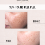 TCA-Peel-Chemical-Peel-Santa-Rosa-Healdsburg