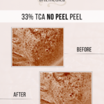 TCA-Peel-Chemical-Peel-Santa-Rosa-Healdsburg