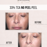 TCA-Peel-Chemical-Peel-Santa-Rosa-Healdsburg