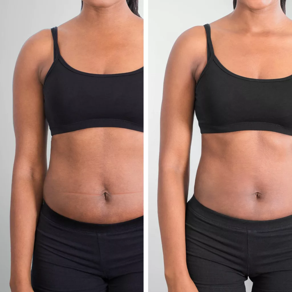 Before and after photos demonstrating body sculpting with an Emsculpt Medical Gym membership at Artemedica