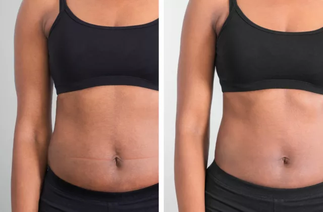 Before and after photos demonstrating body sculpting with an Emsculpt Medical Gym membership at Artemedica