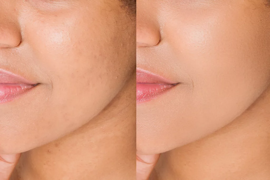 A close up before and after photo after CoolPeel Laser Resurfacing and SkinVive.