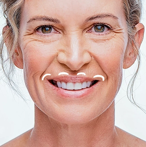 Close up of a middle ages women's face with lines overlaying the upper lip Gummy Smile treatment area for Botox