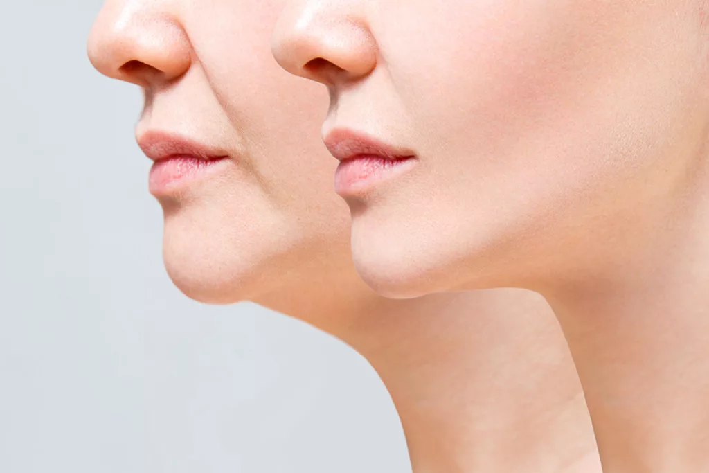 A close up portrait of a woman before and after non-surgical double chin treatment.