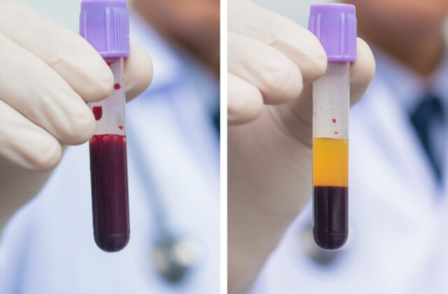 blood before and after going through a centrifuge to create PRP