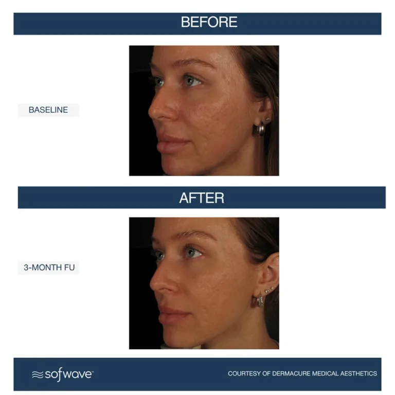 Sofwave skin rejuvenation before and after photos showing reduce in acne scars on the face