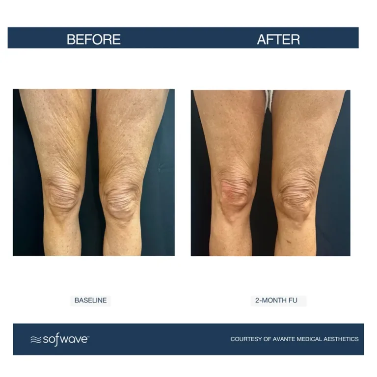Sofwave skin rejuvenation before and after photos showing skin lifting, tightening, and cellulite reduction on the legs and thighs