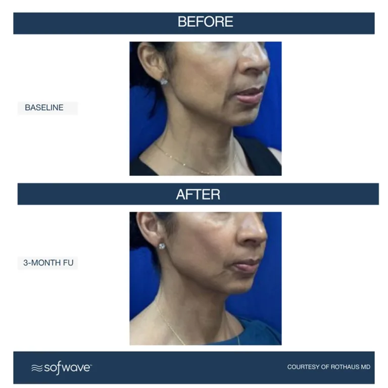 Sofwave skin rejuvenation before and after photos showing skin lifting and tightening on the cheeks and neck