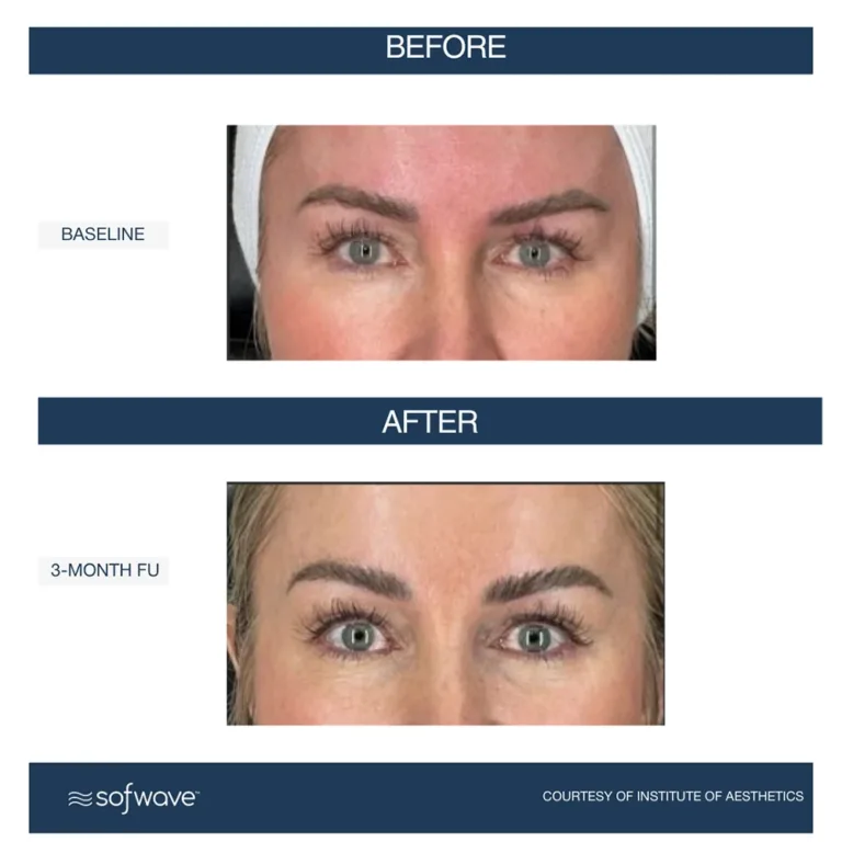 Sofwave skin rejuvenation before and after photos showing skin lifting on the eyebrow area