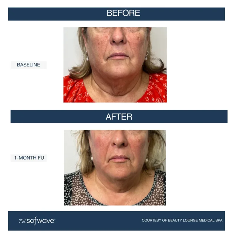 Sofwave skin rejuvenation before and after photos showing skin lifting and wrinkle reduction on the full face, chin, and neck