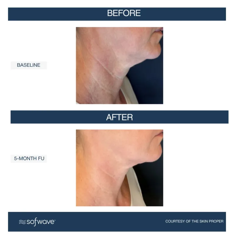 Sofwave skin rejuvenation before and after photos showing skin lifting in the lower face and neck