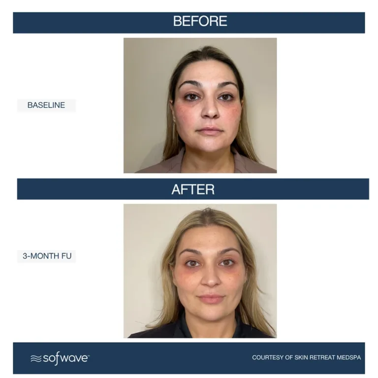 Sofwave skin rejuvenation before and after photos showing skin lifting and toning of the lower face, chin, neck/submentum area