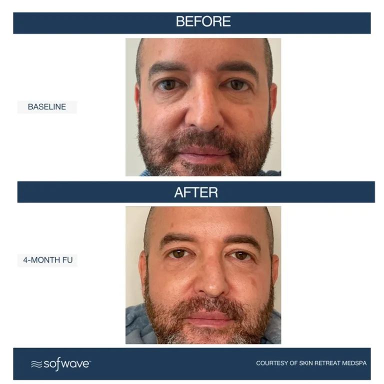 Sofwave skin rejuvenation before and after photos showing wrinkle and under eye bag reduction