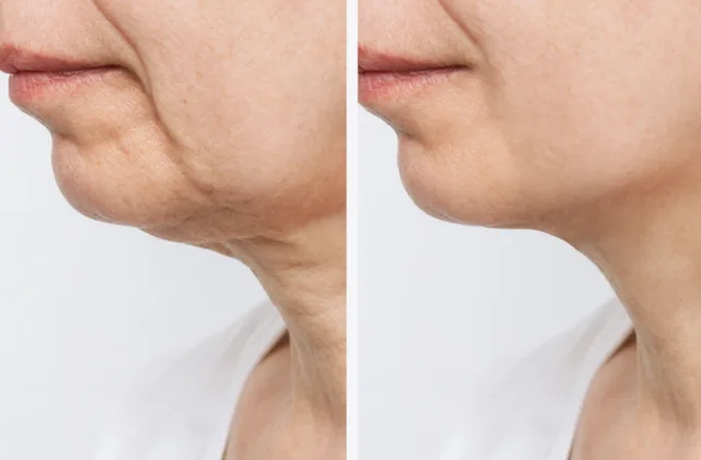 Sofwave skin rejuvenation treatment before and after photos showing skin lifting in the lower face and neck