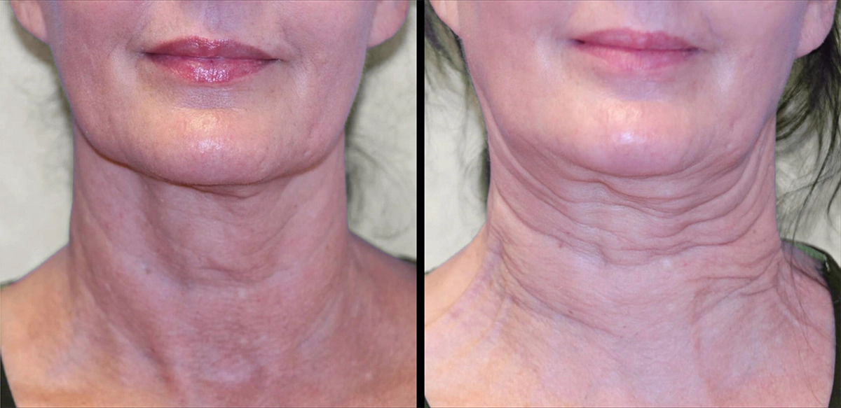 Before and after photos for Sofwave skin rejuvenation treatments, with noticeable improvements in skin laxity, smoothness, and lift