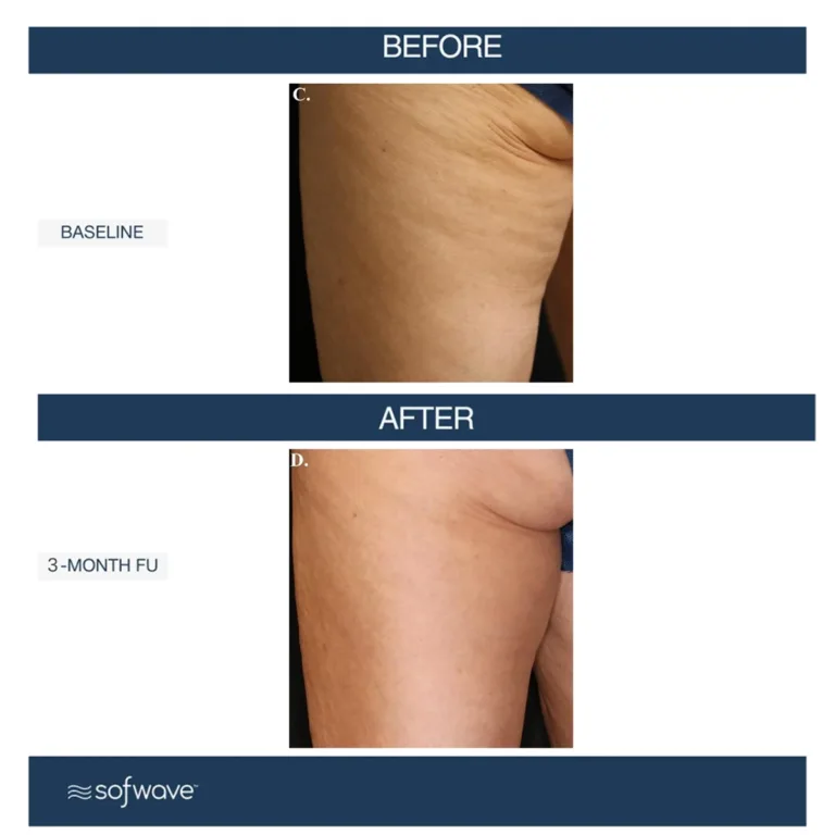Sofwave skin rejuvenation before and after photos showing cellulite reduction in the thighs