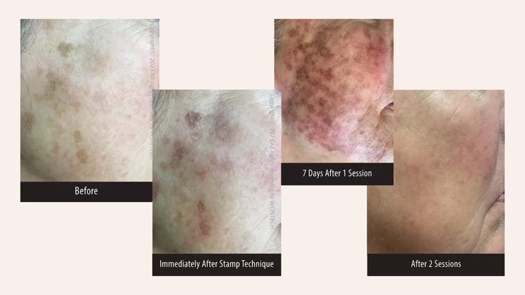 Before and after photos for PicoMajesty laser skin treatment, treating lentigo on the face