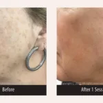 Before and after photos for PicoMajesty laser skin treatment, up close, treating lentigo spots on the face