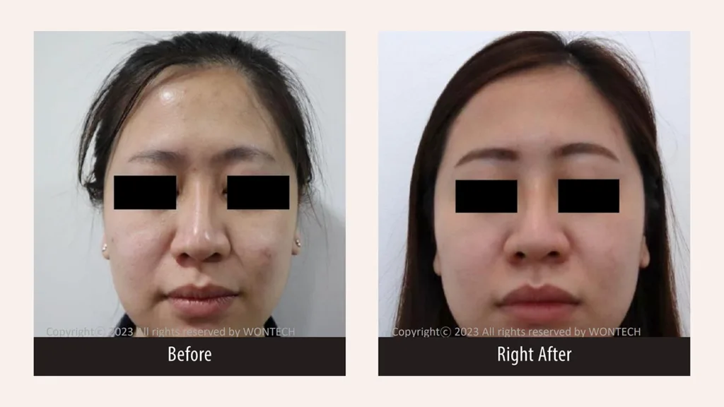 Before and after photos for PicoMajesty laser skin treatment, treating uneven skin tone on the face