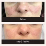 Up close before and after photos for PicoMajesty laser skin treatment, treating post-inflammatory inflammation (PIH) on the face