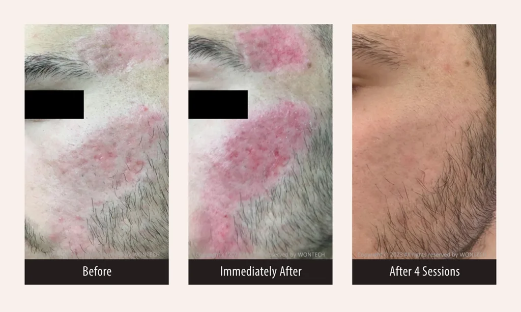 Before and after photos for PicoMajesty laser large pore and acne scar treatment