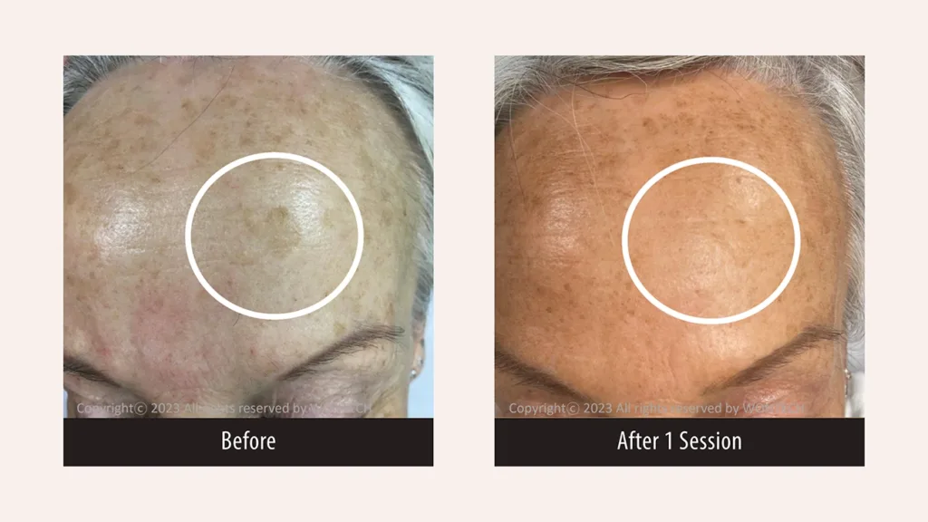 Before and after photos for PicoMajesty age spot removal