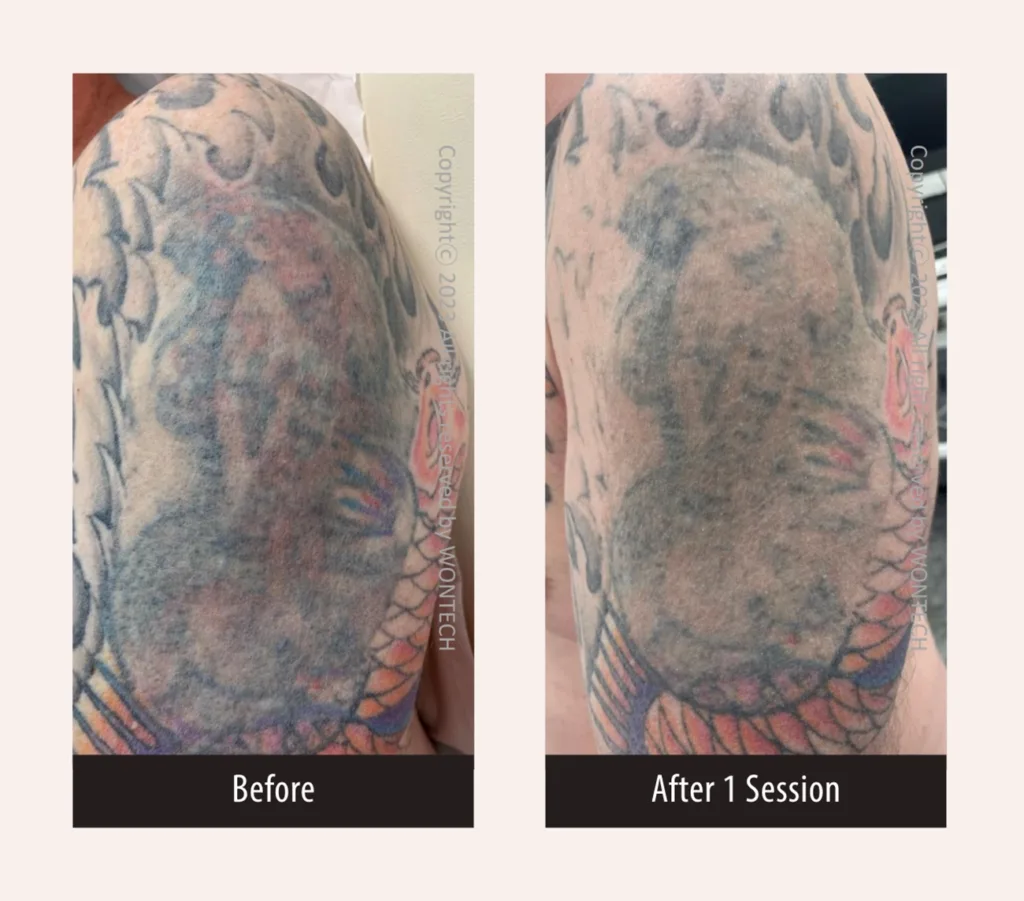 Before and after photos for PicoMajesty laser tattoo removal