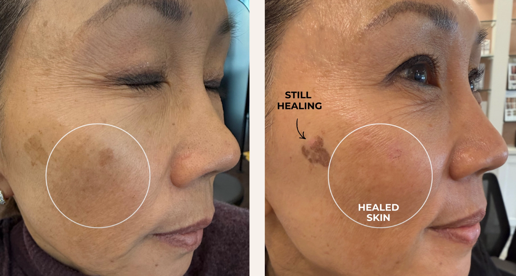 PicoMajesty laser pigmentation treatment before and after at Artemedica