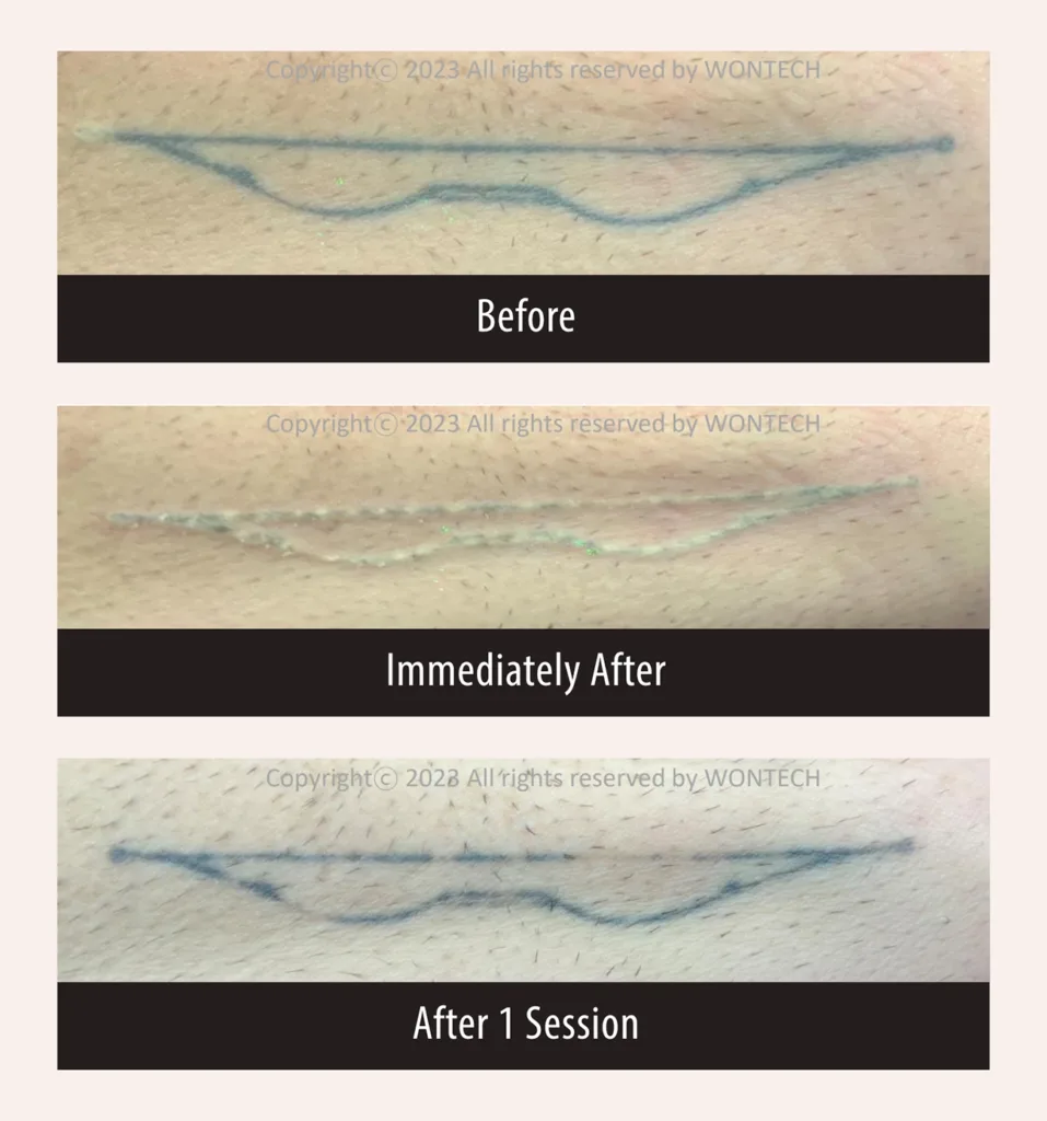 Before and after photos for PicoMajesty laser tattoo removal