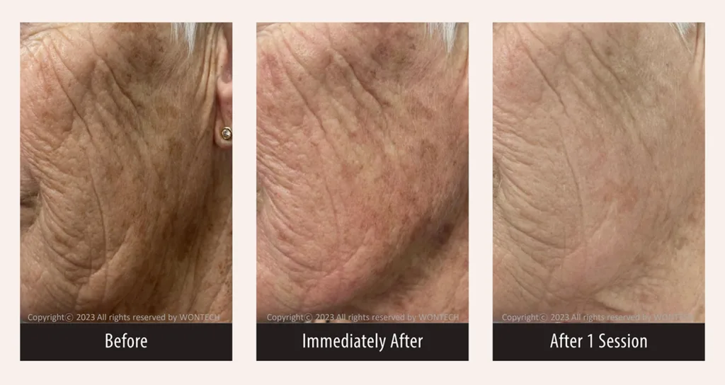 Before and after photos for PicoMajesty lentigines treatment