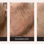 Before and after photos for PicoMajesty lentigines treatment