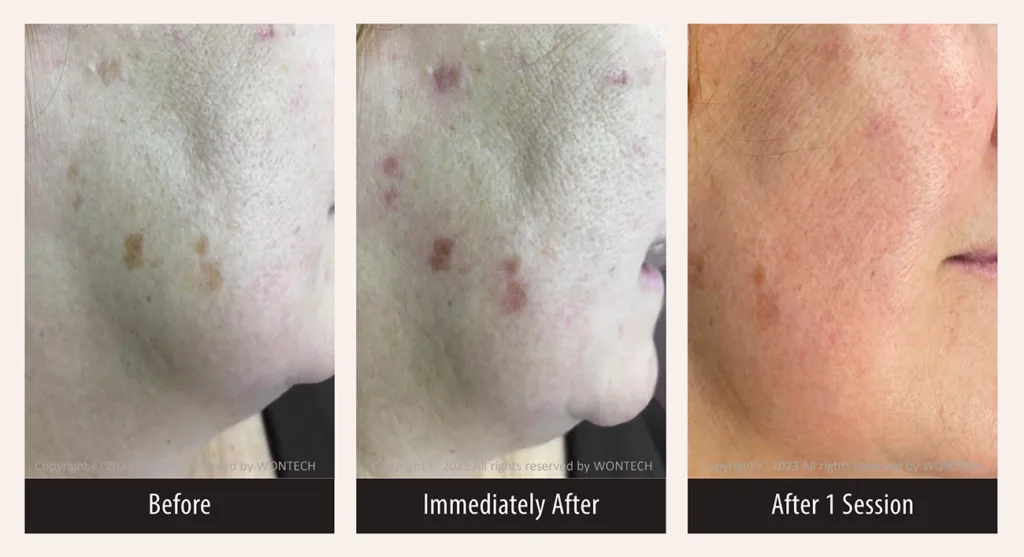 Before and after photos for PicoMajesty lentigines treatment