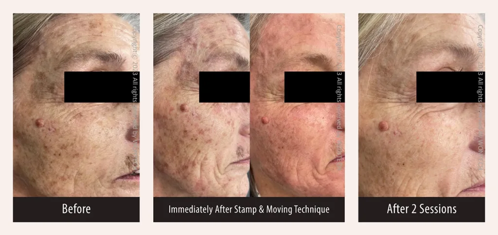 Before and after photos for PicoMajesty laser lentigo removal treatment