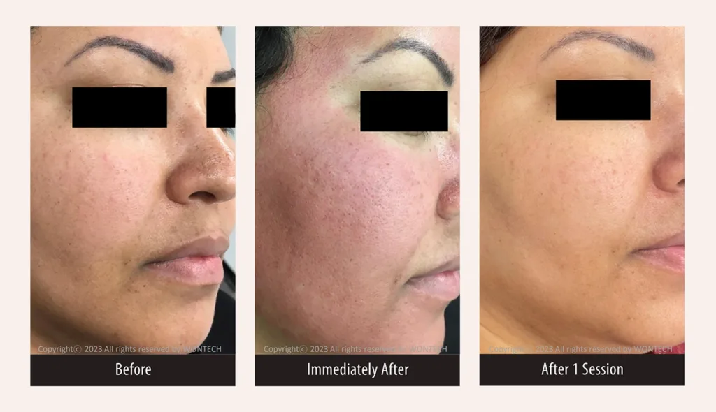Before and after photos for PicoMajesty large pore and acne scar treatment