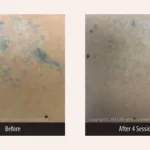Before and after photos for PicoMajesty laser tattoo removal