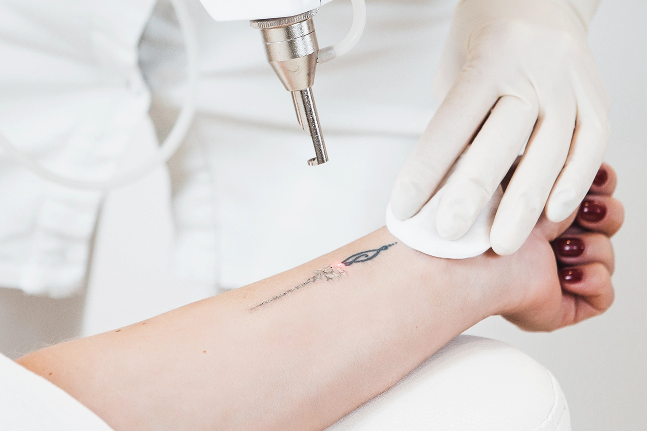 A patient receiving PicoMajesty laser tattoo removal services on the arm