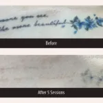Before and after photos for PicoMajesty laser tattoo removal