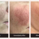 Before and after photos for PicoMajesty laser skin treatment, treating post-inflammatory hyperpigmentation (PIH) on the face