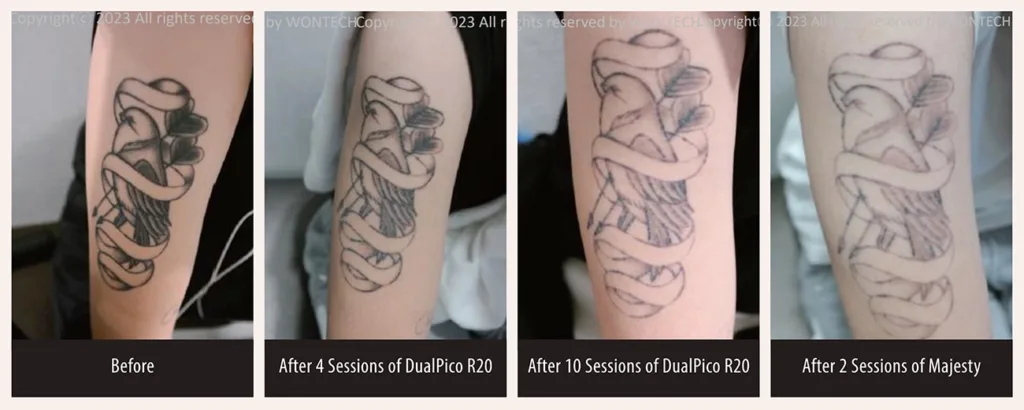 Before and after photos for PicoMajesty laser tattoo removal
