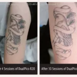Before and after photos for PicoMajesty laser tattoo removal
