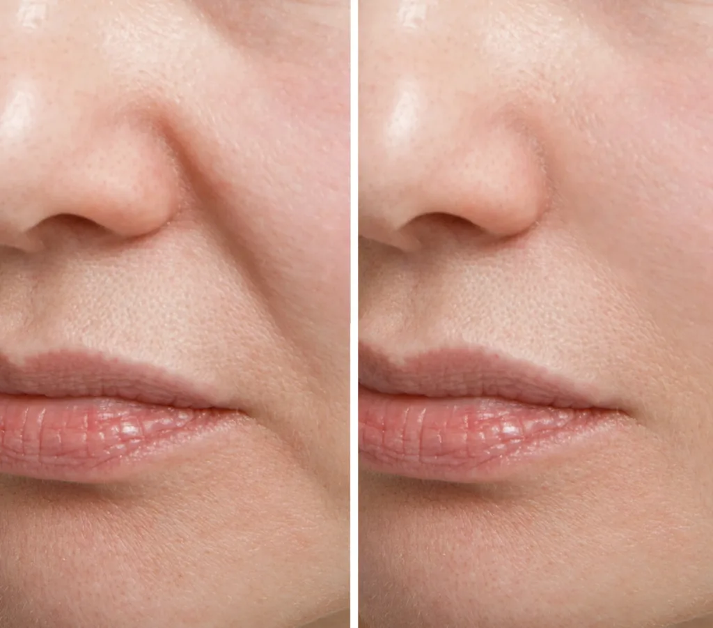 Featured image for Obagi MagIQ injectable hyaluronic acid filler featuring a before and after, side-by-side style close up, of a woman's face with Nasolabial Folds (Smile Lines) running from the nose to the corners of the mouth and Marionette Lines running downward from the corners of the mouth towards the chin in the before picture on the left, and a noticeable reduction in the appearance of all fine lines, wrinkles, and facial folds in the after picture on the right