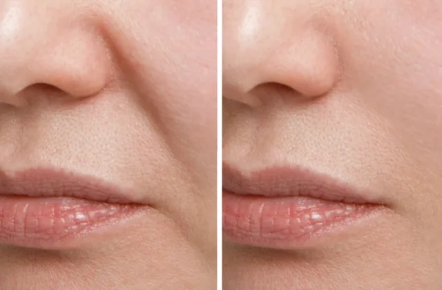 Featured image for Obagi MagIQ injectable hyaluronic acid filler featuring a before and after, side-by-side style close up, of a woman's face with Nasolabial Folds (Smile Lines) running from the nose to the corners of the mouth and Marionette Lines running downward from the corners of the mouth towards the chin in the before picture on the left, and a noticeable reduction in the appearance of all fine lines, wrinkles, and facial folds in the after picture on the right