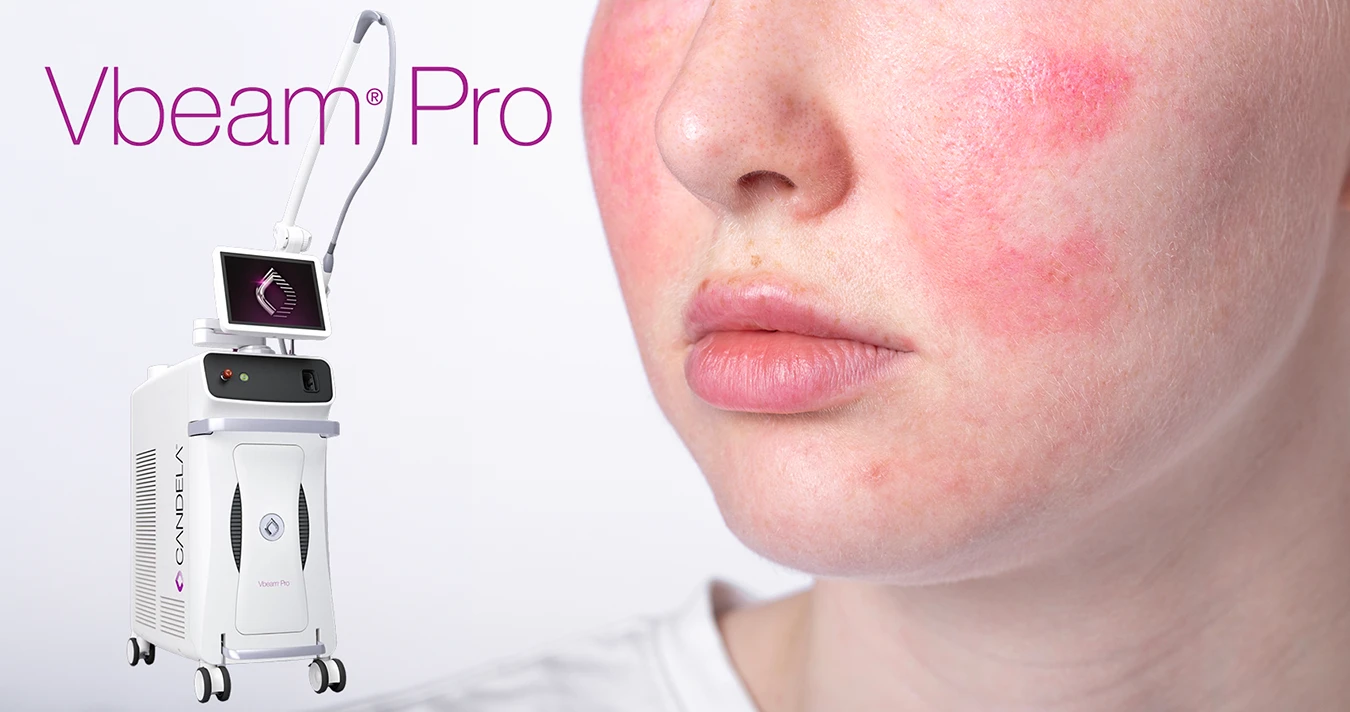 A close up image of a woman's side profile depicting red skin, rosacea, and spider veins, with the Vbeam Pro logo in the top left corner and the Vbeam Pro Laser machine left aligned to the woman's face and underneath the logo.
